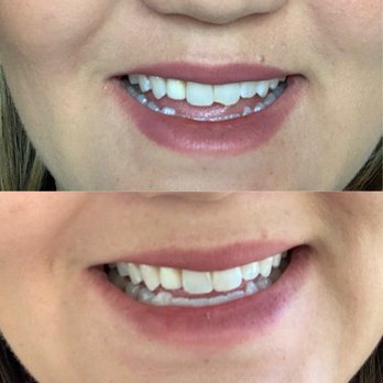 Packard Dental - My before and after chipped tooth! - Orthodontists Near Me - Carlsbad, California
