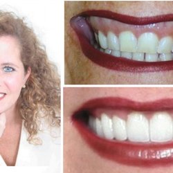 AnaBella Family and Cosmetic Dentistry - Before and After, Full mouth reconstruction