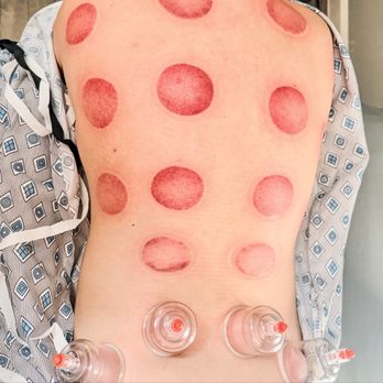 Fern Acupuncture - acupuncture and cupping - Acupuncture Near Me - Vancouver, Washington Fern Acupuncture - acupuncture and cupping - Acupuncture Near Me - Vancouver, Washington