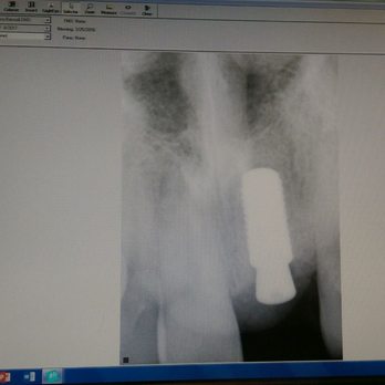 Rana Baroudi, DMD MS - Done! Implant on #8 - Oral Surgeons Near Me - San Jose, California Rana Baroudi, DMD MS - Done! Implant on #8 - Oral Surgeons Near Me - San Jose, California