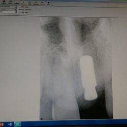 Rana Baroudi, DMD MS - Done! Implant on #8