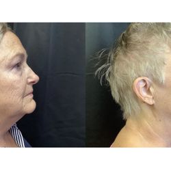 M. Dika Dermatology, S.C. - 12 sessions with TShape-2 by Artemis