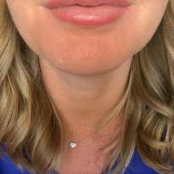 Lip blushing