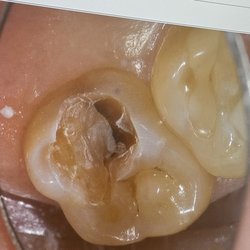 Harris Southwest Dental - My top right tooth before today's filing.  Does this look like a new cavity or something that was visible in September 2024?