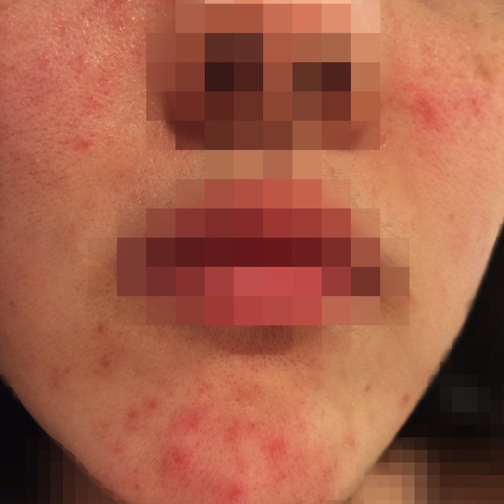 Recoop Spa - What happened on my face after my facial. Horrible!! - Massage Near Me - Bellevue, Washington