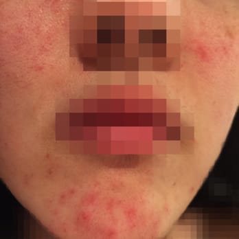 Recoop Spa - What happened on my face after my facial. Horrible!! - Massage Near Me - Bellevue, Washington