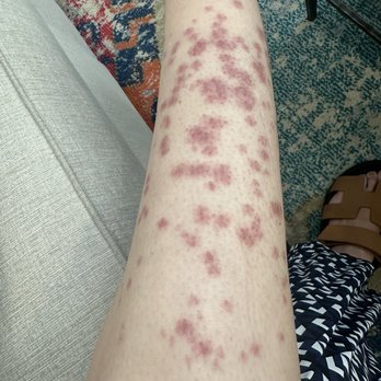 LaserAway - This is my lower leg 4 days after treatment. - Medical Spas Near Me - Las Vegas, Nevada LaserAway - This is my lower leg 4 days after treatment. - Medical Spas Near Me - Las Vegas, Nevada