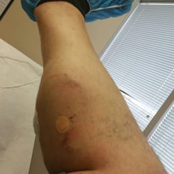 Vein Clinics of America