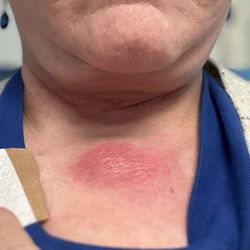Cain Linville, MD, FACS - Burn on my chest - almost 9 months later still have scar.