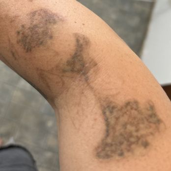 LaserAway - This was a grey tattoo. - Tattoo Removal Near Me - Oakland, California LaserAway - This was a grey tattoo. - Tattoo Removal Near Me - Oakland, California