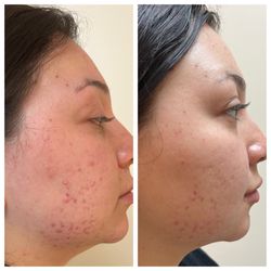 Metamorphosis Skin Studio - Acne results