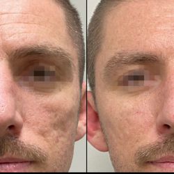SkinRenew Laser Medical Center - Potenza MicroNeedling RF before and after Package of 3