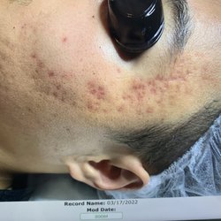 Clear Beauty Acne Clinic - LEFT SIDE AFTER