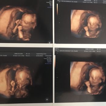 Sweet Baby Face - Ultrasound Imaging Centers Near Me - Louisville, Kentucky