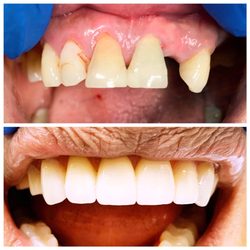Freedom Family Dental - Fort Worth - Veneers and implants made this possible - Dr. McPhee
