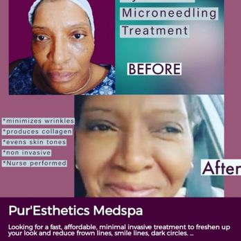 HY-V infusions - Thic client looks 10 years younger after Microneedling with Hyaluronic Serum - IV Hydration Near Me - Atlanta, Georgia HY-V infusions - Thic client looks 10 years younger after Microneedling with Hyaluronic Serum - IV Hydration Near Me - Atlanta, Georgia