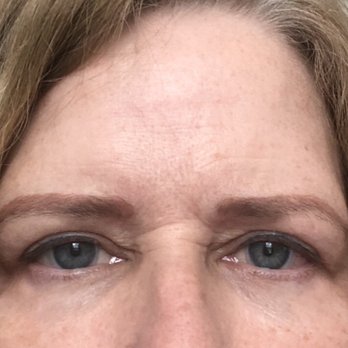 Guy Massry, MD - This picture was taken a week before my surgery. I took both before and after photos. - Cosmetic Surgeons Near Me - Beverly Hills, California