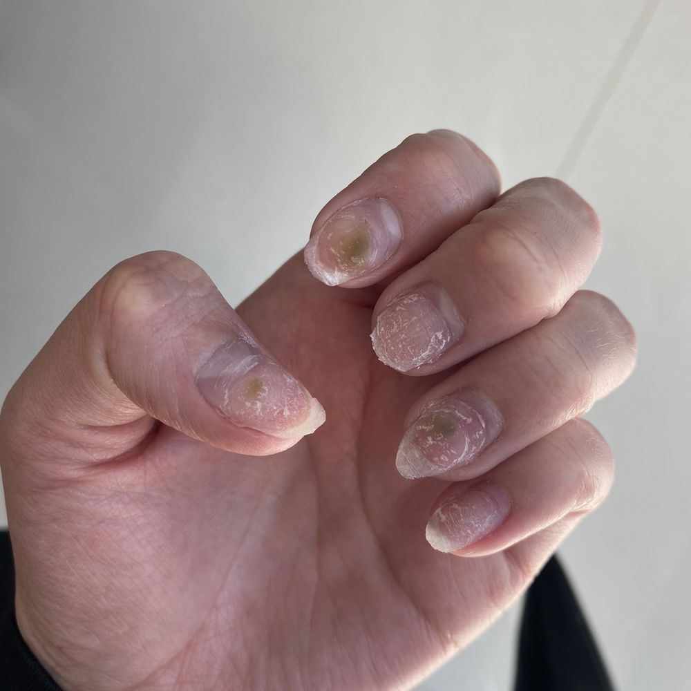 Posh Nails - My nails when I remove the acrylic nail - Nail Salons Near Me - Overland Park, Kansas