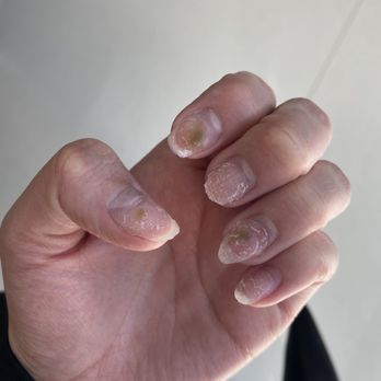 Posh Nails - My nails when I remove the acrylic nail - Nail Salons Near Me - Overland Park, Kansas