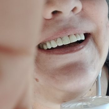 Diamond Bar Dental Studio - Got my upper teeth done bridge on the right and four crowns. Beautiful work. - Cosmetic Dentists Near Me - Diamond Bar, California