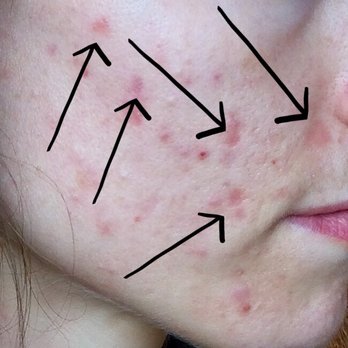 The Image Enhancement Center - These are all of the spots she rubbed as she was doing the peel. The patch by my nose doesnt have the same texture as the rest of my skin. - Cosmetic Surgeons Near Me - Houston, Texas The Image Enhancement Center - These are all of the spots she rubbed as she was doing the peel. The patch by my nose doesnt have the same texture as the rest of my skin. - Cosmetic Surgeons Near Me - Houston, Texas