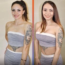 Dolls Plastic Surgery - Breast Augmentation