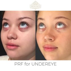 Fresh Faces Rx - Treatment undereye with PRF (Platelet-rich-fribrin) to stimulate collagen and improve the undereye area.