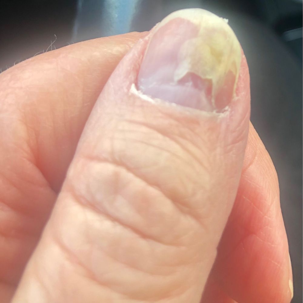 This is 1/1/23, over a month since the appointment. see how she cut my nail (it is not attached to the other parts of my nail)