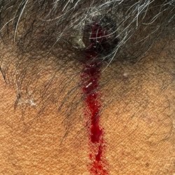 Cardinal Internal Medicine - after removing the Tick