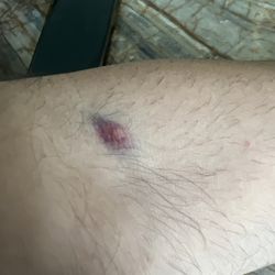 Quest Diagnostics - Location of the blood draw. bruised and swallowen