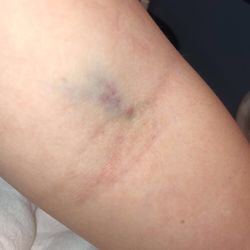 Greer Medical Campus - my arm after the IV