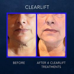 TruYou Body Renewal - Clear Lift Neck!
