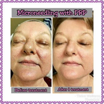 Thrive Wellness - Skin Texture Improvement with Microneedling & PRP. $500 (Value $1500). Fine lines, wrinkles, pore size, collagen production, and much more. - Medical Spas Near Me - Chattanooga, Tennessee Thrive Wellness - Skin Texture Improvement with Microneedling & PRP. $500 (Value $1500). Fine lines, wrinkles, pore size, collagen production, and much more. - Medical Spas Near Me - Chattanooga, Tennessee