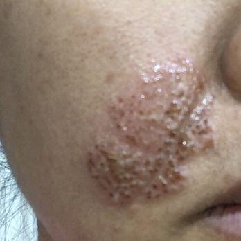 My Perfect Skin Clinic - Day 2 fluid blistering. Very gross looking - Skin Care Near Me - Gilbert, Arizona