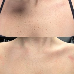 Reborn Laser Clinic - Solar lentigines removal before and after treatment at Reborn Laser Clinic.