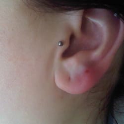 Pagan - Bruised and swollen stud-less second lobe piercing.