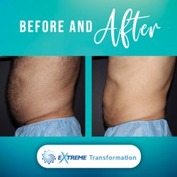 Bodenvy CoolSculpting & Weight Loss Tulsa - Fat Reduction Tulsa