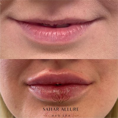 Lip Fillers - At Sahar Allure Med Spa, we believe people truly look their best when they feel their best. Sahar Alnsour RN has a passion for changing lives, and she can't wait to make a difference in yours! Through Advanced Skin Care Technology, Dermal Fillers, Medical Grade Facials, Laser Hair Removal, Vitamin IV Therapy and more, we are giving your skin a glowing, more youthful look. All of our treatments are backed by science, and our in-house doctor oversees your skin's health throughout your whole journey, ensuring that it stays radiant! So come on down, sit back, and relax -- we'll make you feel beautiful inside and out! We look forward to seeing you soon! Lip Fillers - At Sahar Allure Med Spa, we believe people truly look their best when they feel their best. Sahar Alnsour RN has a passion for changing lives, and she can't wait to make a difference in yours! Through Advanced Skin Care Technology, Dermal Fillers, Medical Grade Facials, Laser Hair Removal, Vitamin IV Therapy and more, we are giving your skin a glowing, more youthful look. All of our treatments are backed by science, and our in-house doctor oversees your skin's health throughout your whole journey, ensuring that it stays radiant! So come on down, sit back, and relax -- we'll make you feel beautiful inside and out! We look forward to seeing you soon!