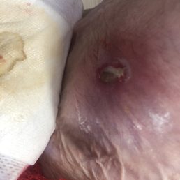 They say this was not infected.  Sore on her ankle.