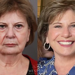West End Plastic Surgery - Dr. Paul Ruff performed a Deep Plane Face & Neck Lift, Brow Lift, Eyelid Lift, Fat Grafting, and CO2 Resurfacing