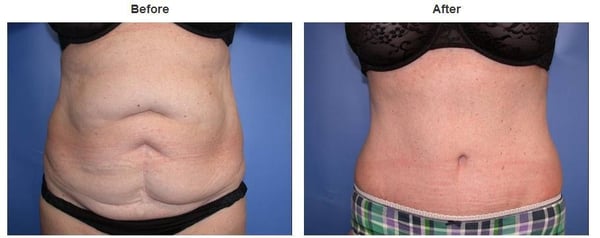 Photo of Suzanne Quardt MD - Palm Desert Plastic Surgery - Rancho Mirage, CA, US. Plastic Surgery Before & After Pictures https://palmdesertplasticsurgery.com/photo-gallery/