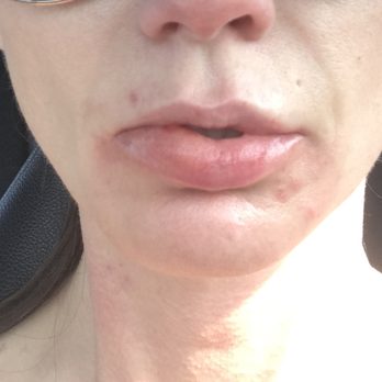 Frontline ER Dallas - Swollen painful lips. Doctor saying these scabies weren't real and would not listen to me. - Emergency Rooms Near Me - Dallas, Texas