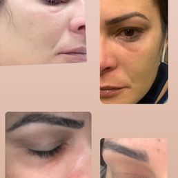 Under-eye filler Under-eye filler