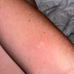 Bug bite