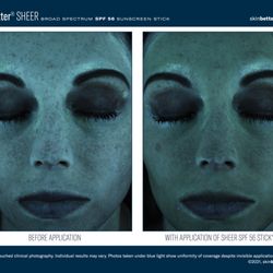 Medical Skin Aesthetics - Mineral Sunblocks are best. Oxybenzone is controversial due to potential hormone effects, skin reactions, and environmental harm.