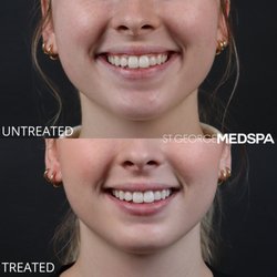 St George Med Spa - Before and after lip flip
