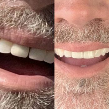 Arrowhead Dental Center - Mark Willis before and after. - Cosmetic Dentists Near Me - Gardnerville, Nevada Arrowhead Dental Center - Mark Willis before and after. - Cosmetic Dentists Near Me - Gardnerville, Nevada