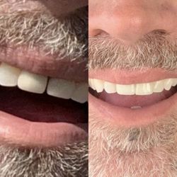 Arrowhead Dental Center - Mark Willis before and after.