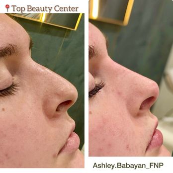 Top Beauty Center - Non-Surgical nose job - Medical Spas Near Me - Los Angeles, California Top Beauty Center - Non-Surgical nose job - Medical Spas Near Me - Los Angeles, California