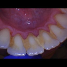 Before bottom teeth Before bottom teeth
